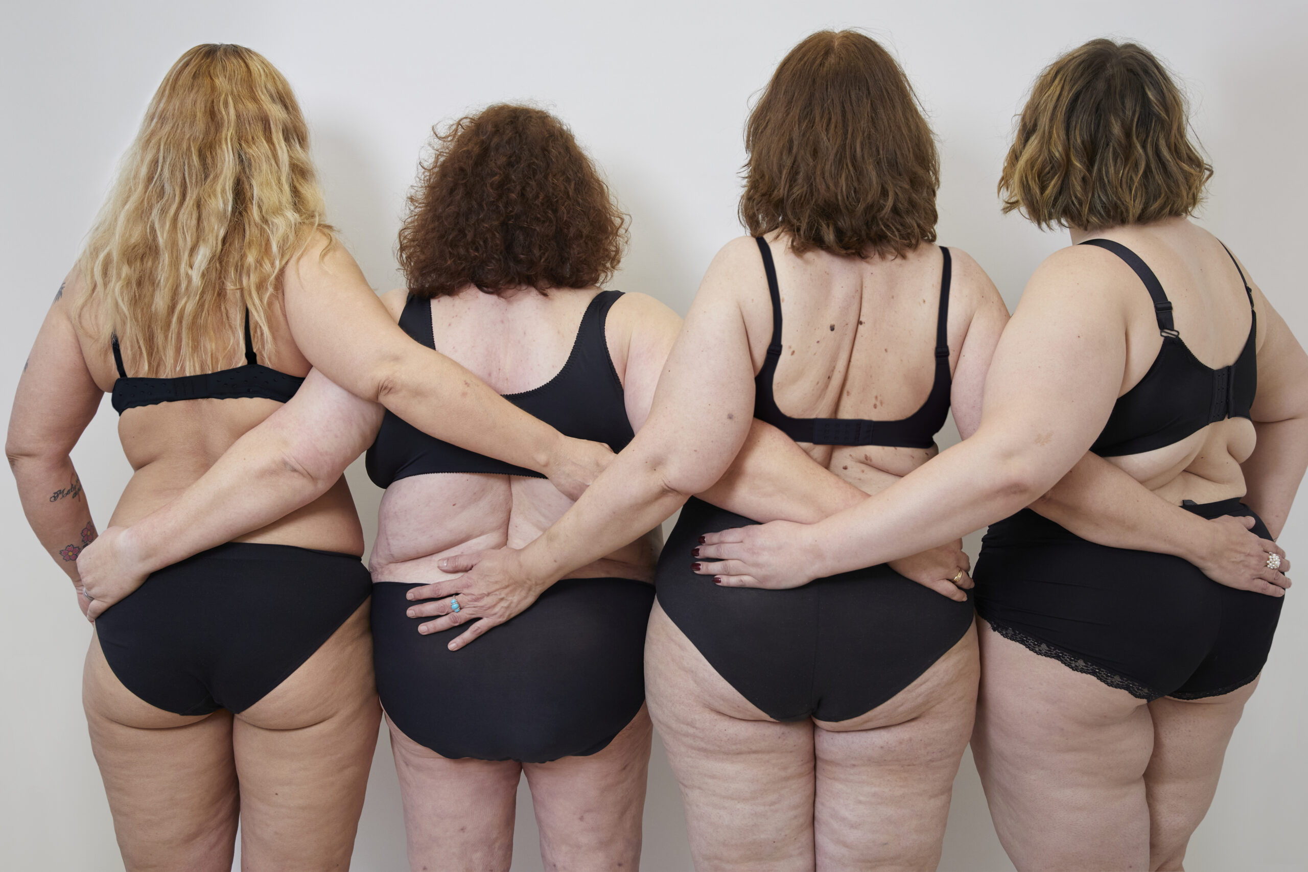 Lipedema Stage 1: What Are The Signs?